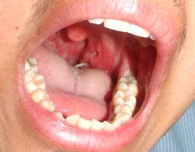 fish_bone_in_oropharynx_762x595_g