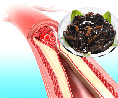 Anatomy of Atherosclerosis