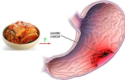 Kimchi cancer
