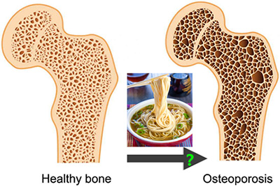 osteoperosis noodle